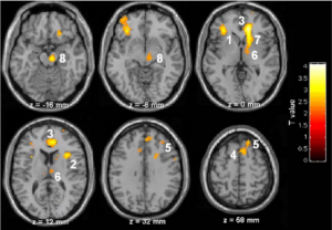 Рис. 4. Регионы, в которых отмечено повышенное взаимодействие со среднепоясной корой в гипнозе: (1) левый островок, (2) правой островок, (3) периколенная кора, (4) преддополнительная моторная кора, (5) верхняя лобная извилина, (6) таламус, (7) правое хвостатое ядро, (8) средний мозг/ствол мозга. (Адаптировано, Faymonville et al., 2003).